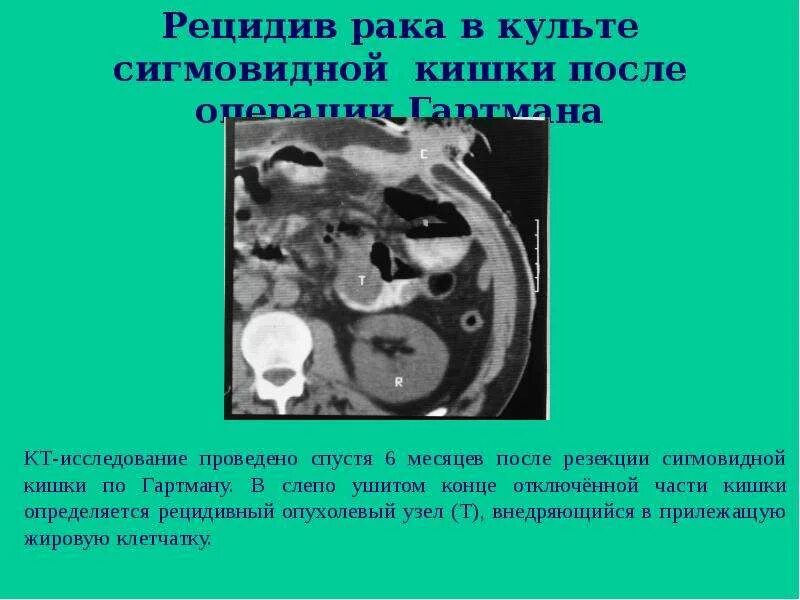 Рак сигмовидной кишки прогноз после операции отзывы. Опухоль сигмовидной кишки. сигмовидная кишка онкология. опухоль сигмовидную кишку и кишечник.