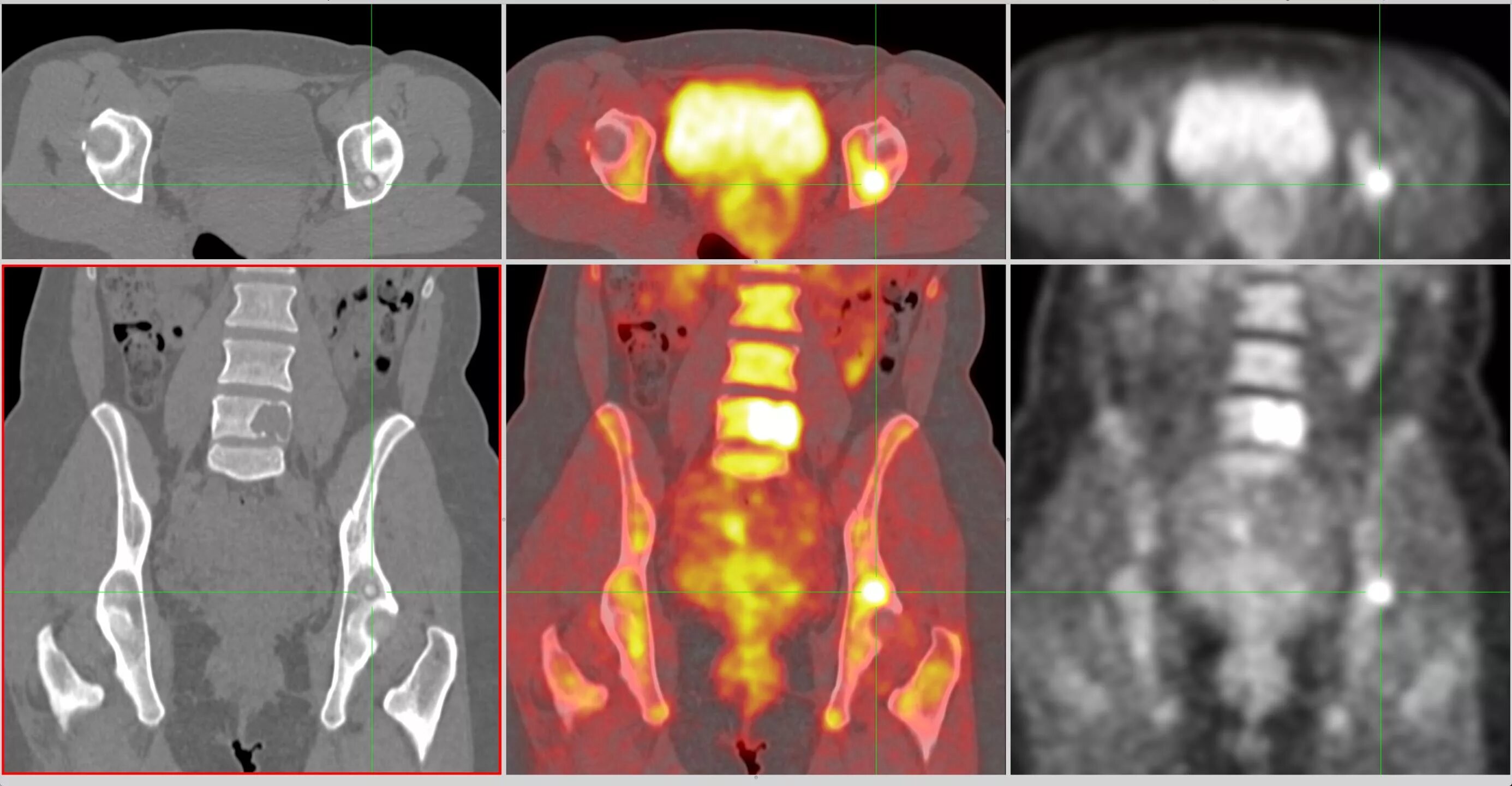 Позитронно-эмиссионная томография метастазы. Позитронно эмиссионная томография почек. Как пройти пэт кт