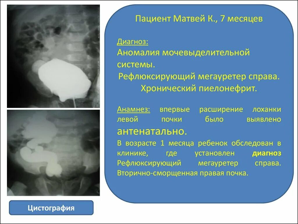 Мегауретер у детей что это. Рефлюксирующий мегауретер. рефлексирующий мегауретер у детей. цистография пиелонефрит.