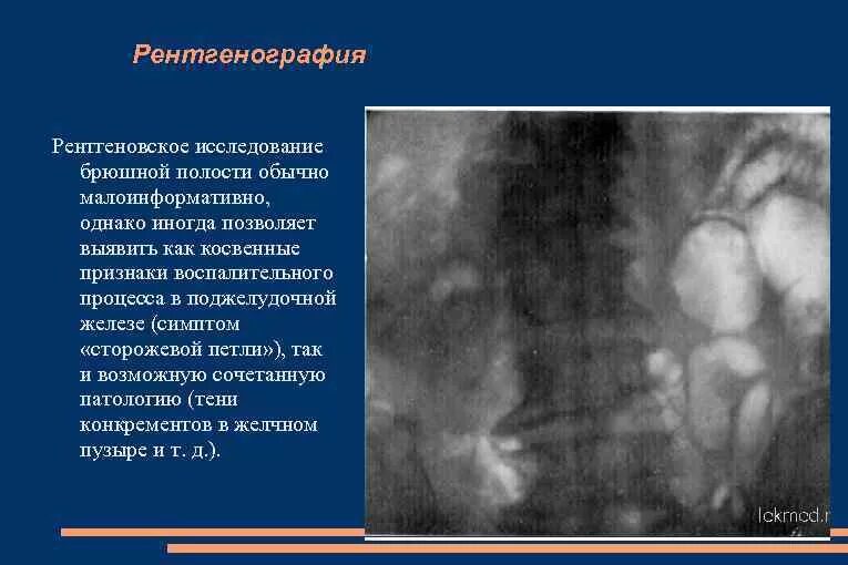 Рентген признаки острого панкреатита. Панкреатит рентген признаки. Панкреатит обзорная рентгенография. Рентгеновский признак острого панкреатита.