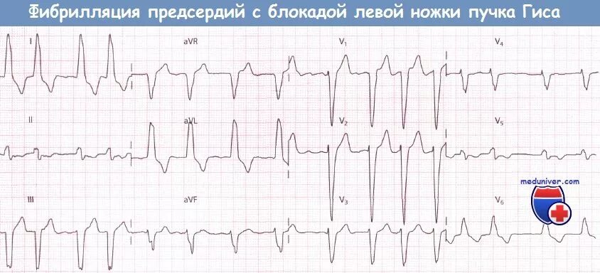 Фибрилляция предсердий с блокадой. Фибрилляция предсердий и блокада левой ножки пучка гиса экг. экг фибрилляция предсердий блокада левой пучка гиса. фибрилляция предсердий с блокадой левой ножки пучка гиса. фибрилляция предсердий на фоне полной ав блокады экг.