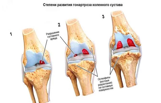 Изменения в коленных суставах. Дистрофические изменения коленного сустава. Гонартроз коленного сустава. Диспластический гонартроз. Дегенеративно-дистрофические изменения в суставе.