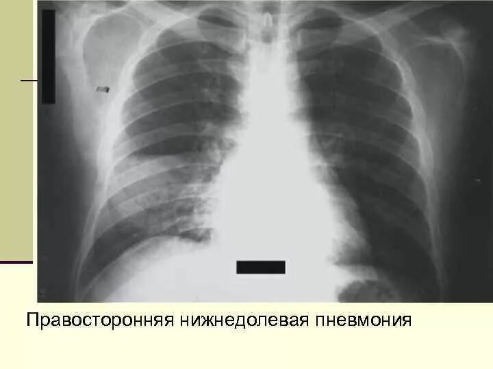 Пневмония в правой нижней доле. Нижнедолевая очаговая пневмония рентген. Правосторонняя очаговая пневмония рентген. Правосторонняя нижнедолевая очаговая пневмония рентген. Нижнедолевая пневмония справа рентген.