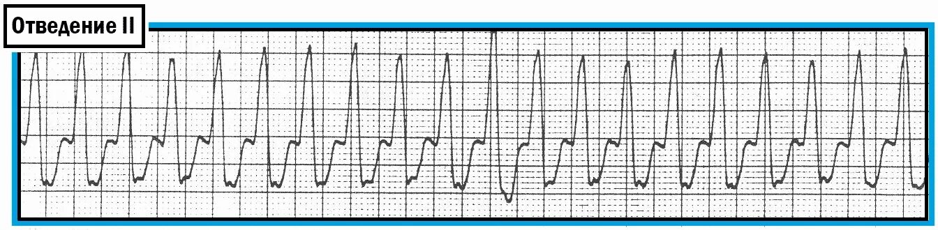Широкий комплекс qrs. Широкий комплекс qrs на экг. желудочковая тахикардия с широкими комплексами на экг. пароксизмальная тахикардия с широким комплексом qrs на экг. суправентрикулярная тахикардия с широкими комплексами экг.