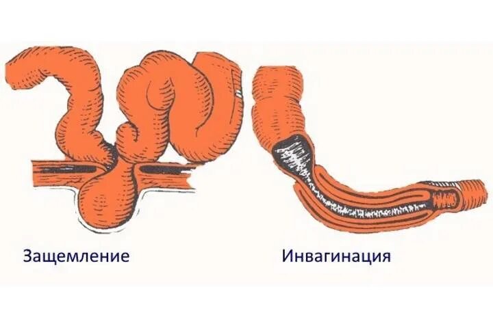 Инвагинация тонкой кишки. Острая кишечная непроходимость инвагинация. Обтурационная непроходимость. Илеоцекальная инвагинация кишечника.