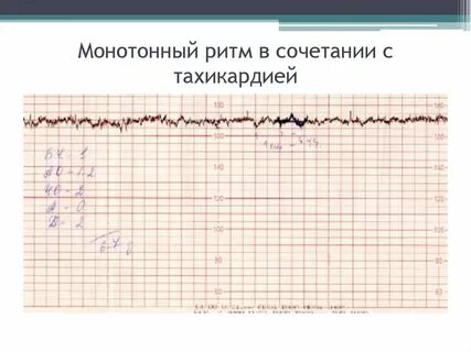 Тахикардия у плода