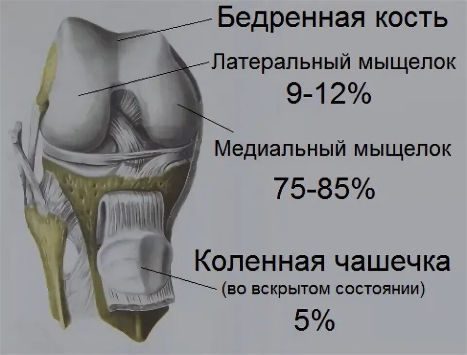 Изменение латерального мыщелка. Болезнь кенига коленного. медиальные мыщелки коленного сустава. рассекающий остеохондрит коленного сустава локализация. рассекающий остеохондрит медиального мыщелка бедренной кости.