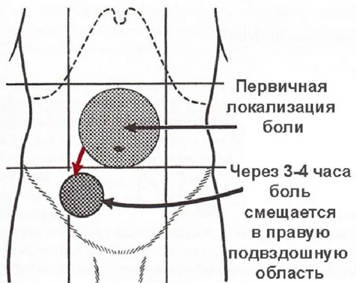 При аппендиците сильная боль. Локализация аппендицита. Подвздошная область живота справа.