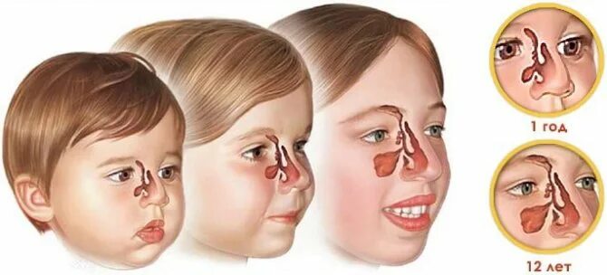 Аденоиды в носовых пазухах у детей. Вазомоторный ринит,гайморит. Воспаленные аденоиды в носу.