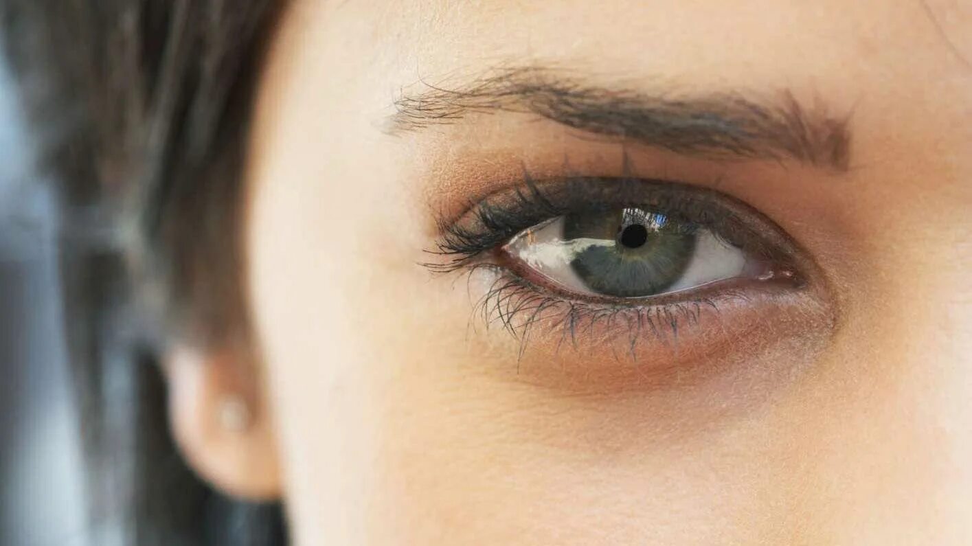 Синюшность под глазами. Круги под глазами. Синие круги од глазами. Фиолетовые круги под глазами. Красные синички под глазами.