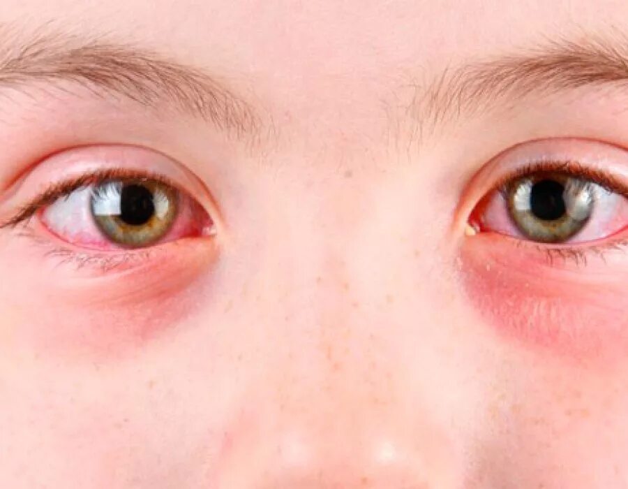 Аллергический конъюнктивит глаза у детей. Аллергическийконъюктивит у ребёнка.