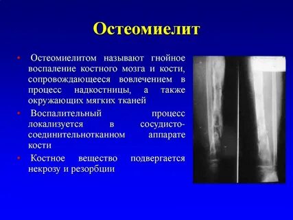 Остеомиелит кости признаки
