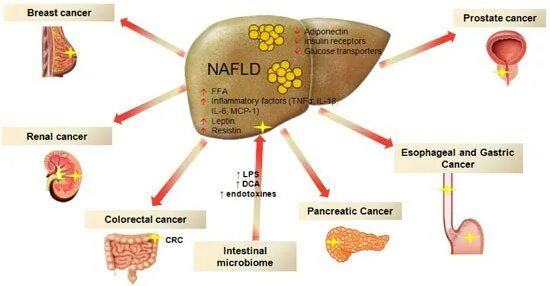 Жировая болезнь печени. Жировое поражение печени. Неалкогольная жировая болезнь печени.
