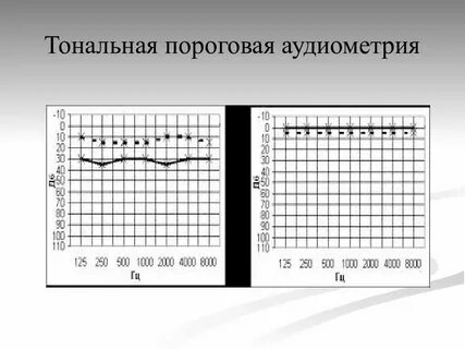 Аудиометрия что это за процедура