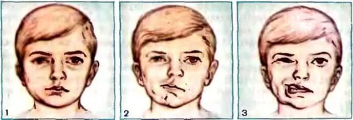 Парез латынь. Периферический паралич синкинезии. Неврит лицевого нерва Центральный паралич. Парез лицевых мышц у детей. Парез лицевого нерва синдром.