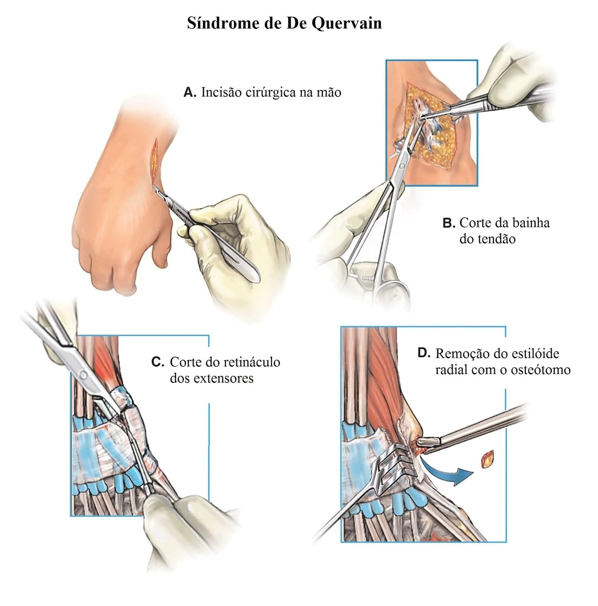 Болезнь де Кервена операция. Болезнь де Кервена кисти. Тендовагинит де Кервена. Синдром Кервена лучезапястного сустава.