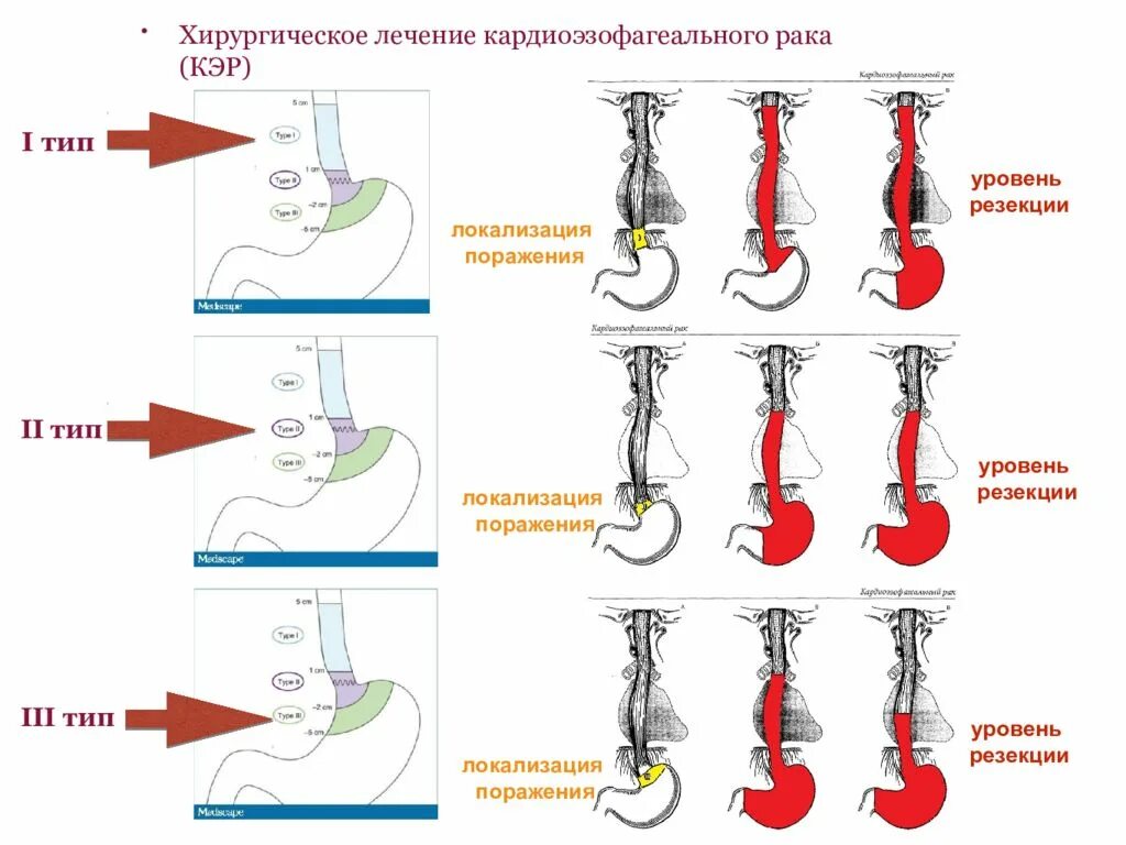 Хирургическое лечение пищевода. Классификация по зиверту. Кардиоэзофагеальный переход. Кардиоэзофагеальный переход пищевода. Кардиоэзофагеальная зона.