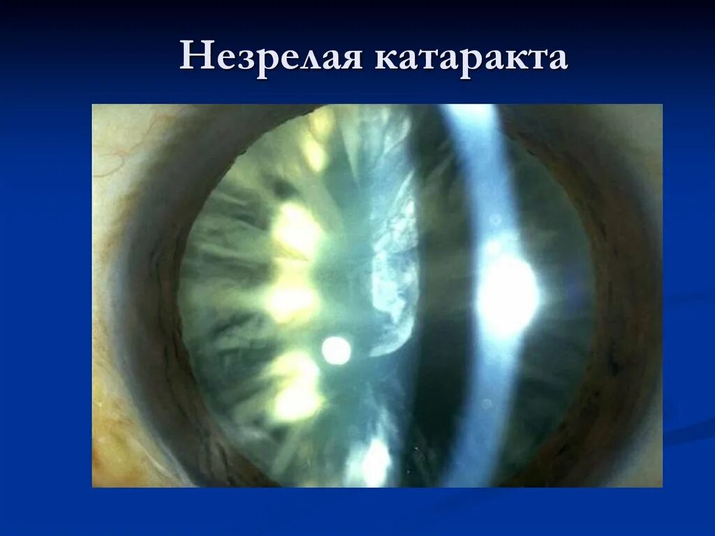 Начальная старческая катаракта. Кортикальная катаракта. Корковая катаракта глаза. Катаракта морганиева катаракта. Незрелая корковая катаракта.