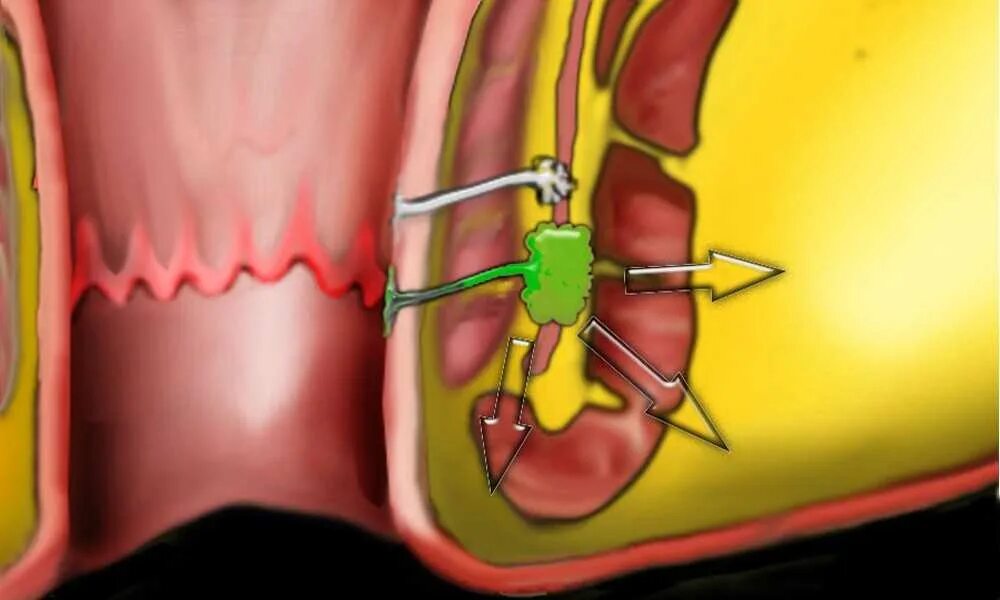 Трещина после заднего прохода. Межсфинктерный абсцесс.