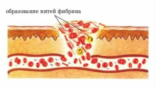 Заживление раны фибрин. Образование нитей фибрина. Тромб нити