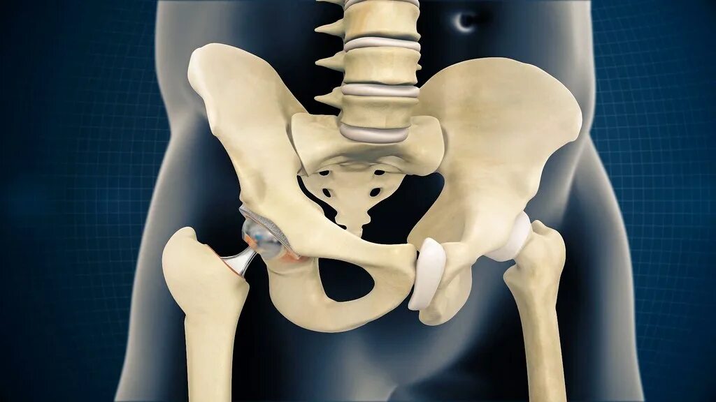 Loosened hip replacement, X-ray - Stock Image - F003/3631 - Science Photo Librar