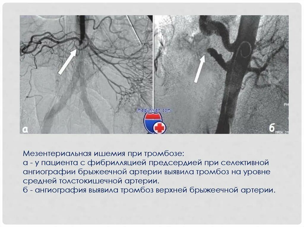 Брюшная ишемия. Ангиография тромбоз мезентериальных сосудов. Тромбоз мезентериальных сосудов на кт. Эмболия верхней брыжеечной артерии клиника. Верхняя мезентериальная Вена кт.