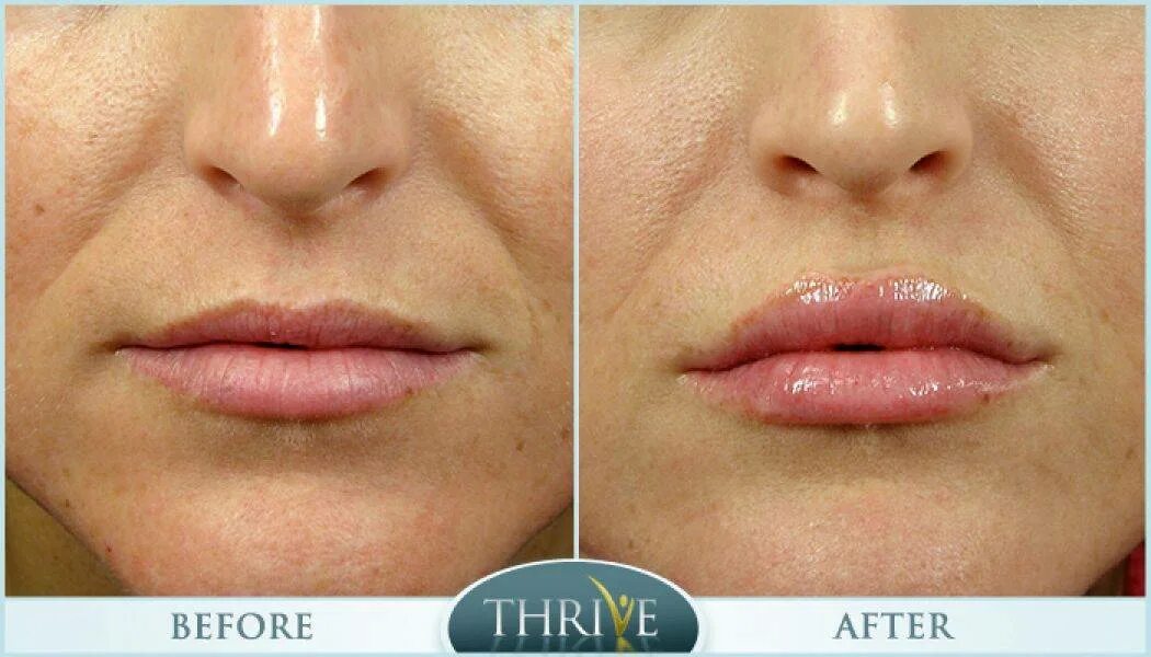 Новое видео. Увеличим губы и посмотрим результат - vzbeauty.ru