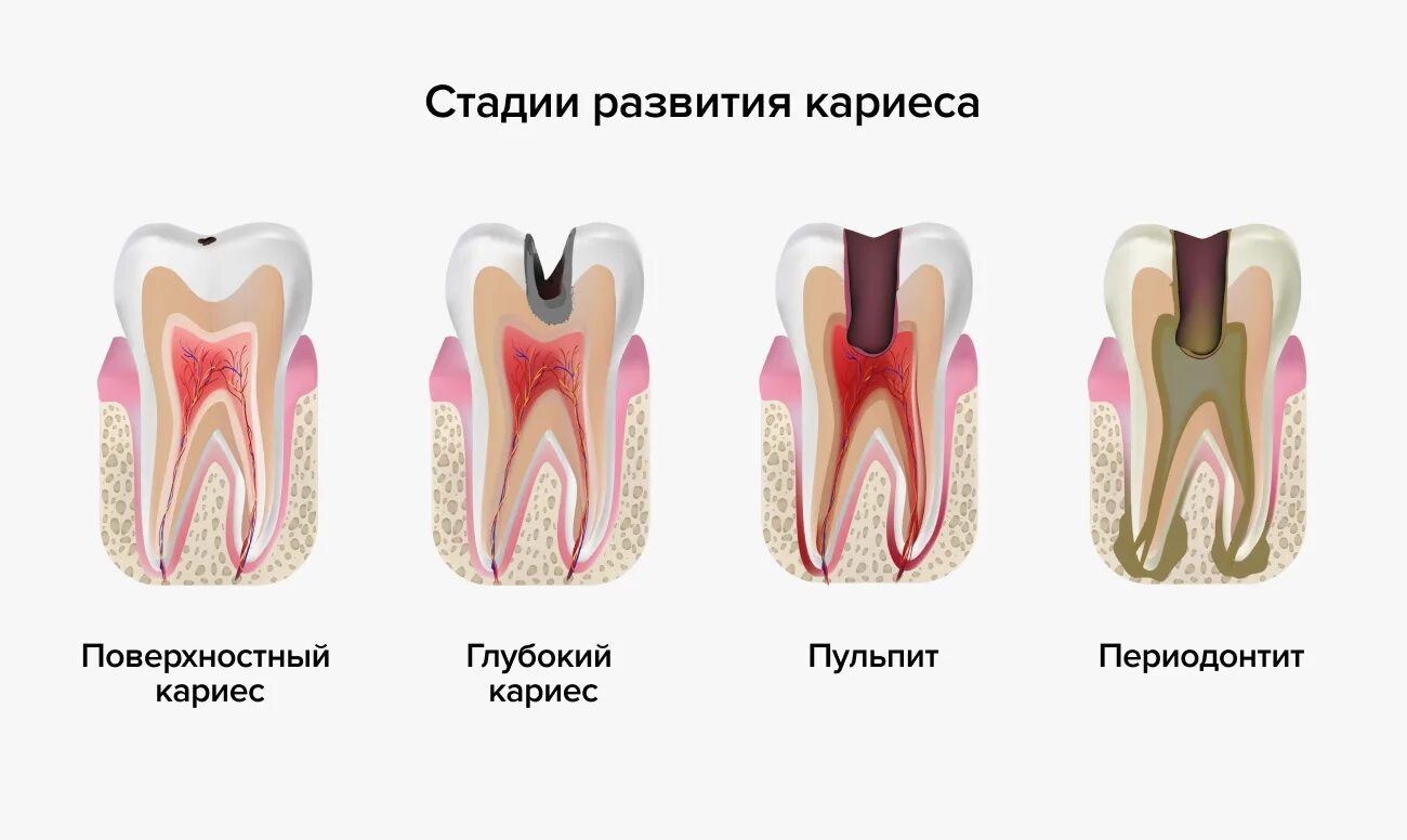 На начальном этапе можно. Кариес пульпит периодонтит. Зубы кариес пульпит периодонтит. Острый серозный периодонтит. Острый Гнойный периодонтит патогенез.