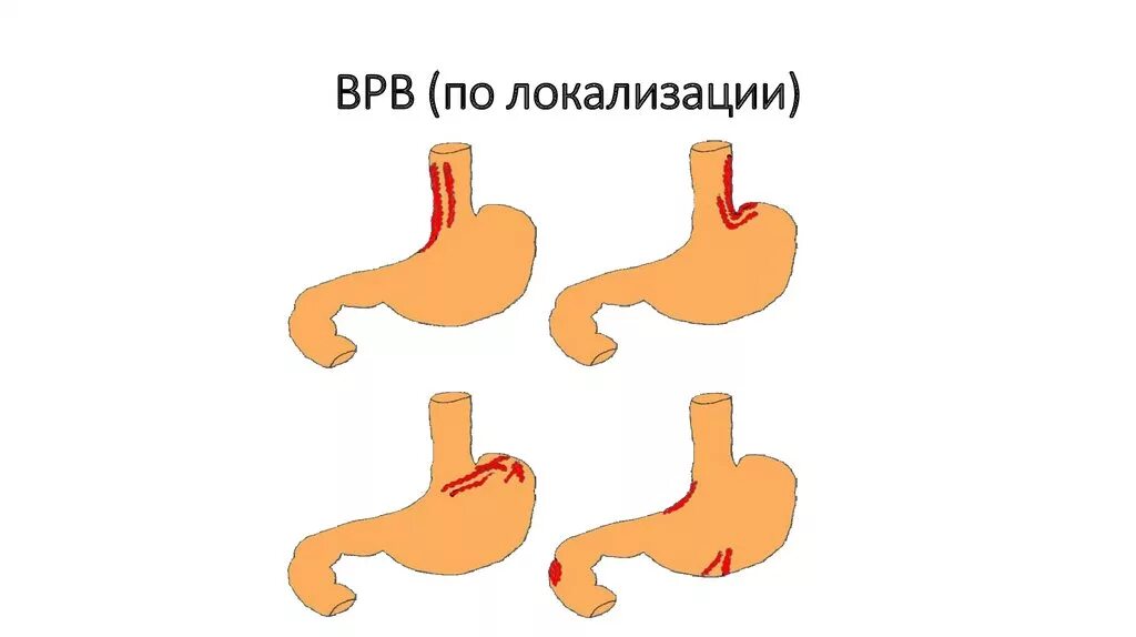 Расширен пищевод желудка. Классификация ВРВ желудка по локализации. Классификация варикозно расширенных вен желудка. Варикозное расширение вен пищевода классификация. Степени варикозного расширения вен пищевода классификация.