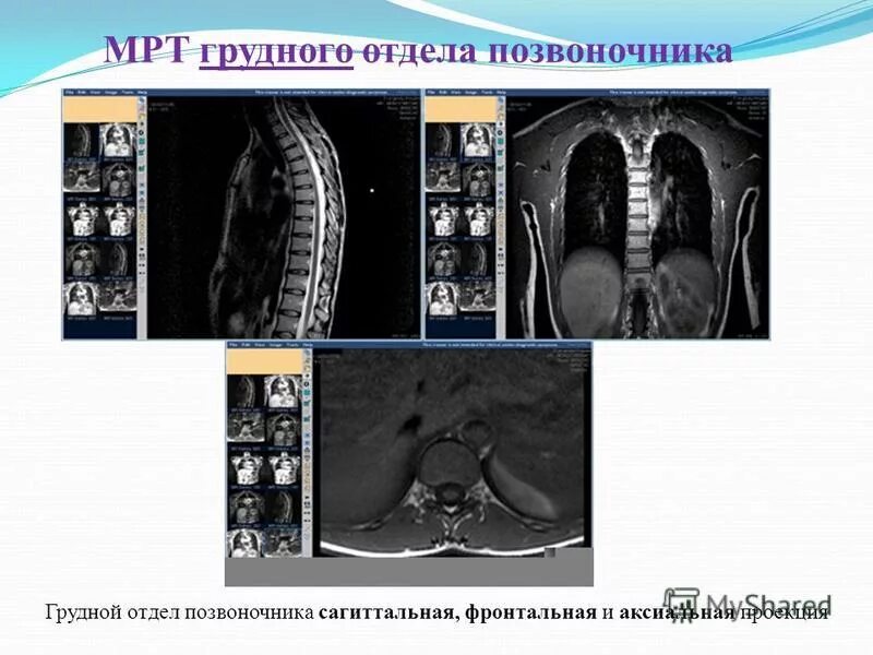 Мрт спинного отдела. Аксиальная проекция мрт. Мрт грудного отдела. Мрт позвоночника. Мрт грудного отдела позвоночника.