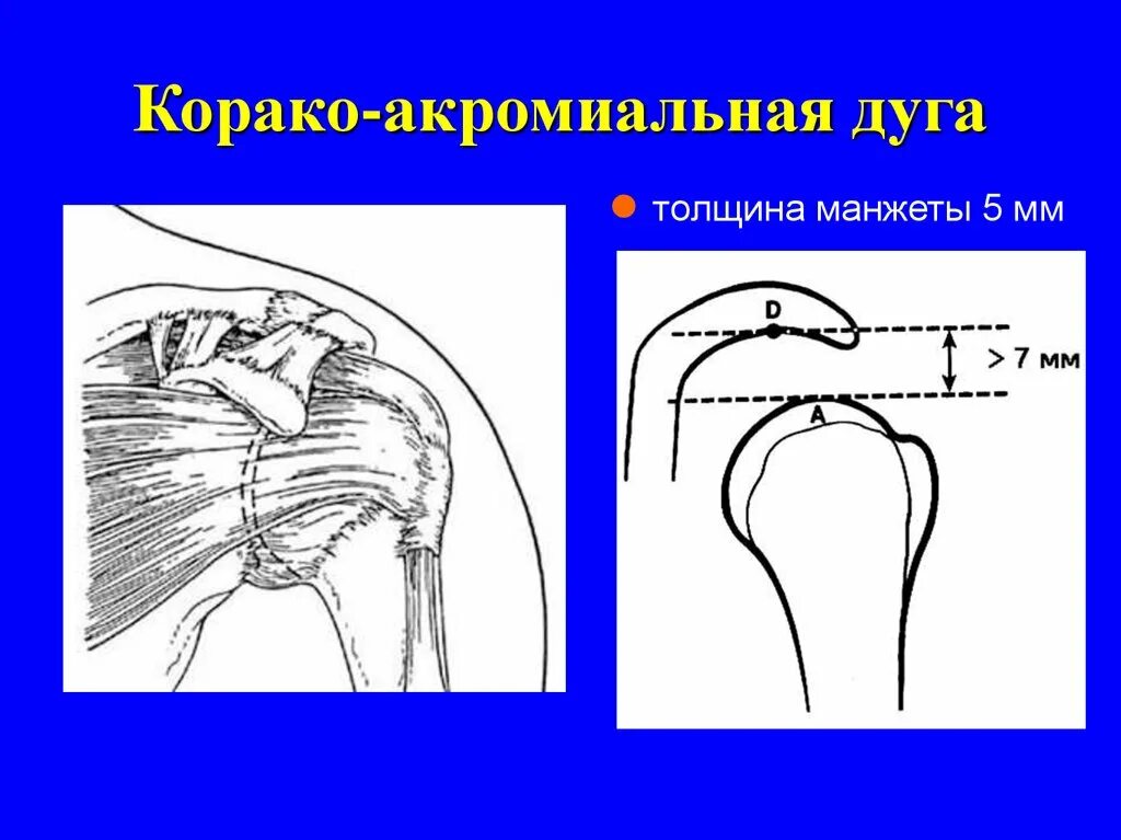Импиджмент синдром плечевого сустава что это такое. Подакромиальный импинджмент синдром плечевого сустава. субакромиальное пространство плечевого сустава. субакромиальный импиджмент плечевого сустава. импиджмент синдром плечевого сустава.