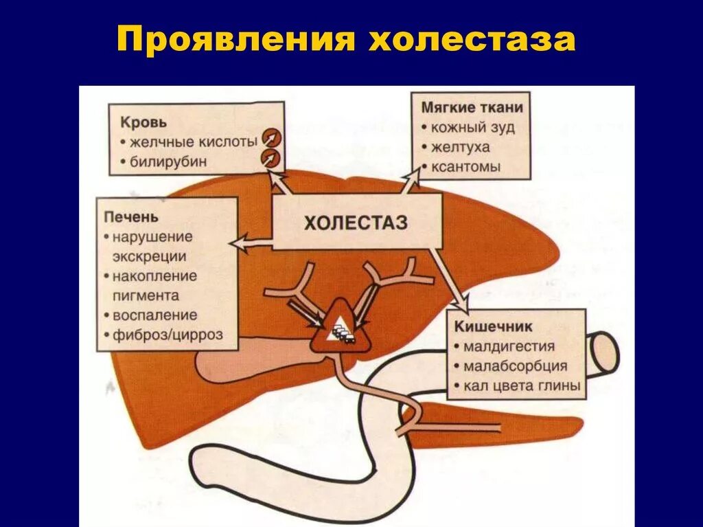 Синдром внутрипеченочного холестаза симптомы. Синдром внутрипеченочного холестаза патогенез. Внепеченочные проявления холестаза. УЗИ внутрипечёночный холестаз печени. Холестаз печени симптомы