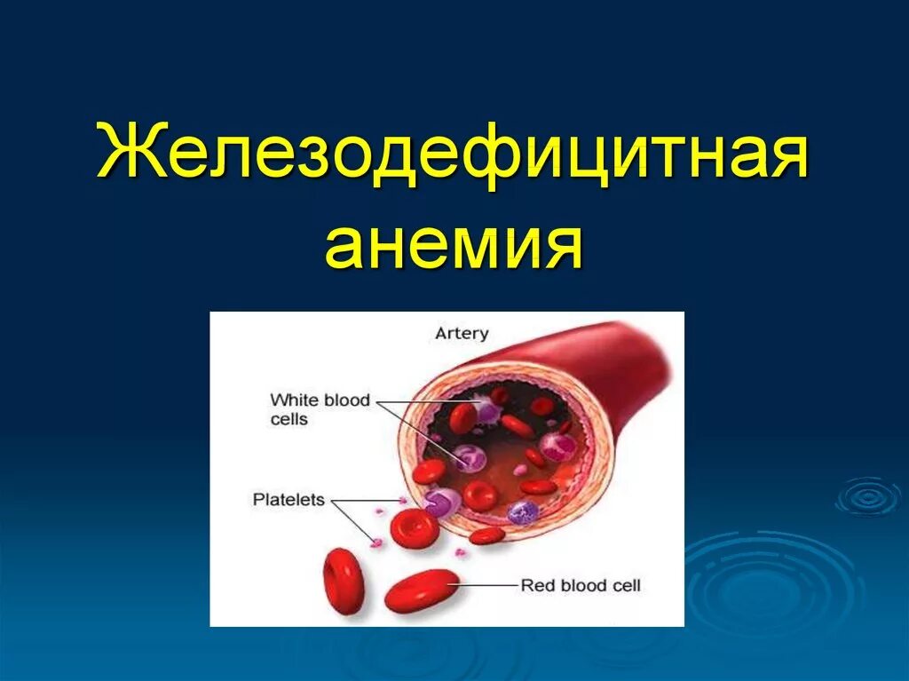 Анемия и эритроциты в крови. Причины развития жда. Анемия железодефицитная эритроциты в крови. Б13 железодефицитная анемия. Железодефицитная анем.