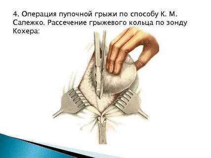 Виды операций пупочных грыж