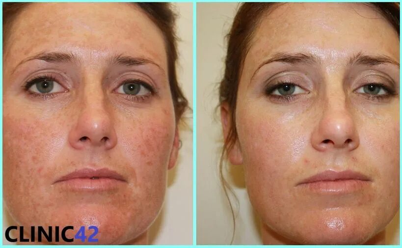 Пилинг джесснера эффект. Пилинг джесснера эффект. Пилинг. Пилинг джесснера эффект. Пилинг для лица.