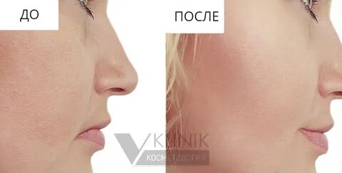 Дренажная мезотерапия
