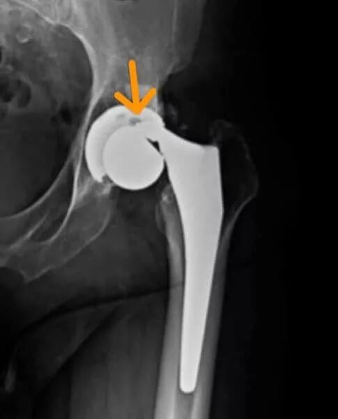 Эндопротез плечевого сустава рентген. Расшатывание эндопротезов. Расшатывание эндопротезов. Эндопротез depuy производитель тазобедренного сустава. Delta xtend эндопротез плечевого сустава.