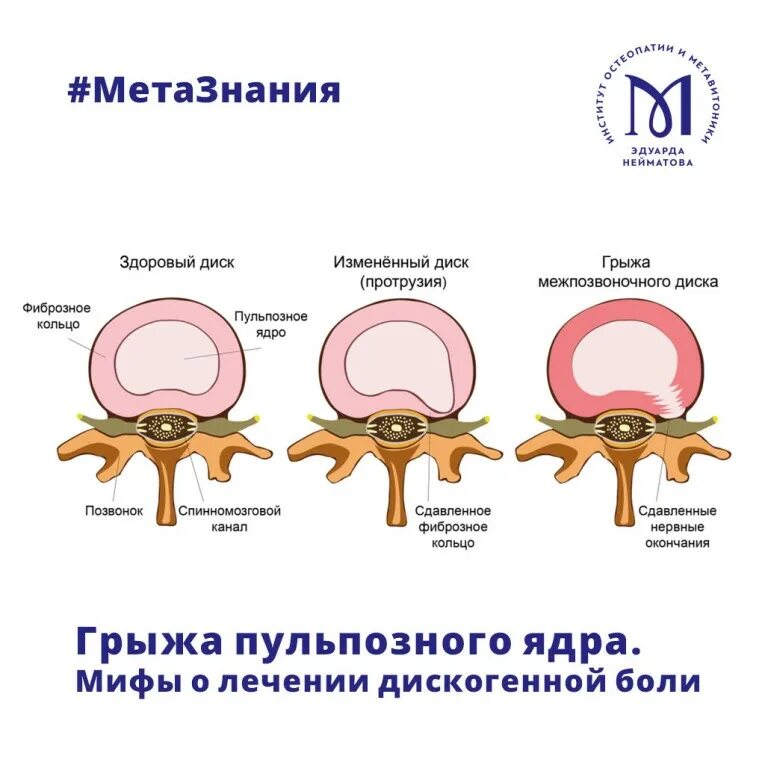 Дорзальная протрузия диска что это такое. Грыжа позвоночника пульпозное ядро. фиброзное кольцо и пульпозное ядро. пульпозное ядро межпозвоночного диска функция. строение пульпозного ядра межпозвоночного диска.