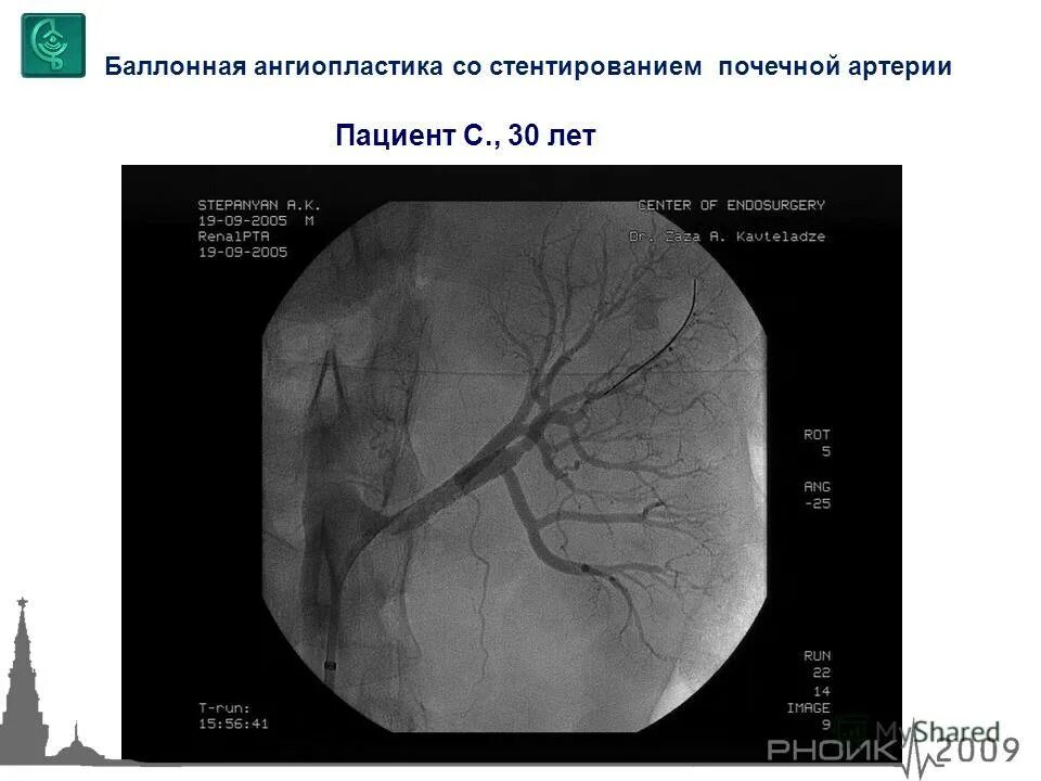Стентирование сосудов почек. Стентирование почечных артерий показания. Рестеноз коронарных артерий после стентирования. Стентирование коронарных артерий схема. Тромбоз почечной артерии кт.