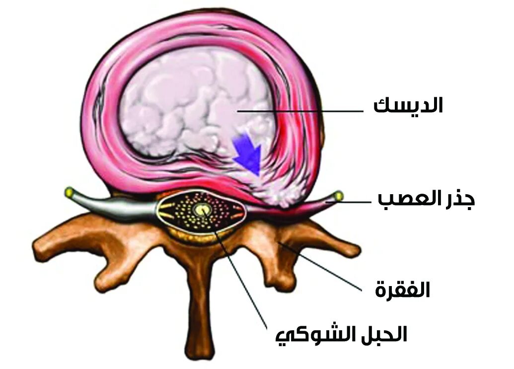 Поражение корешковых нервов. Межпозвоночная грыжа пульпозное ядро. Фиброзное кольцо межпозвоночного диска. Пульпозное ядро и фиброзное кольцо. Синдром сдавления корешка l3.