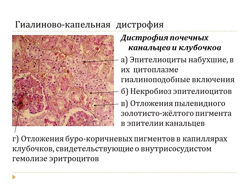 Гиалиново-капельная дистрофия почечных канальцев микропрепарат. Гидропическая дистрофия почки. Паренхиматозные дистрофии гиалиново капельная. Гиалиново-капельная дистрофия эпителия извитых канальцев почки.