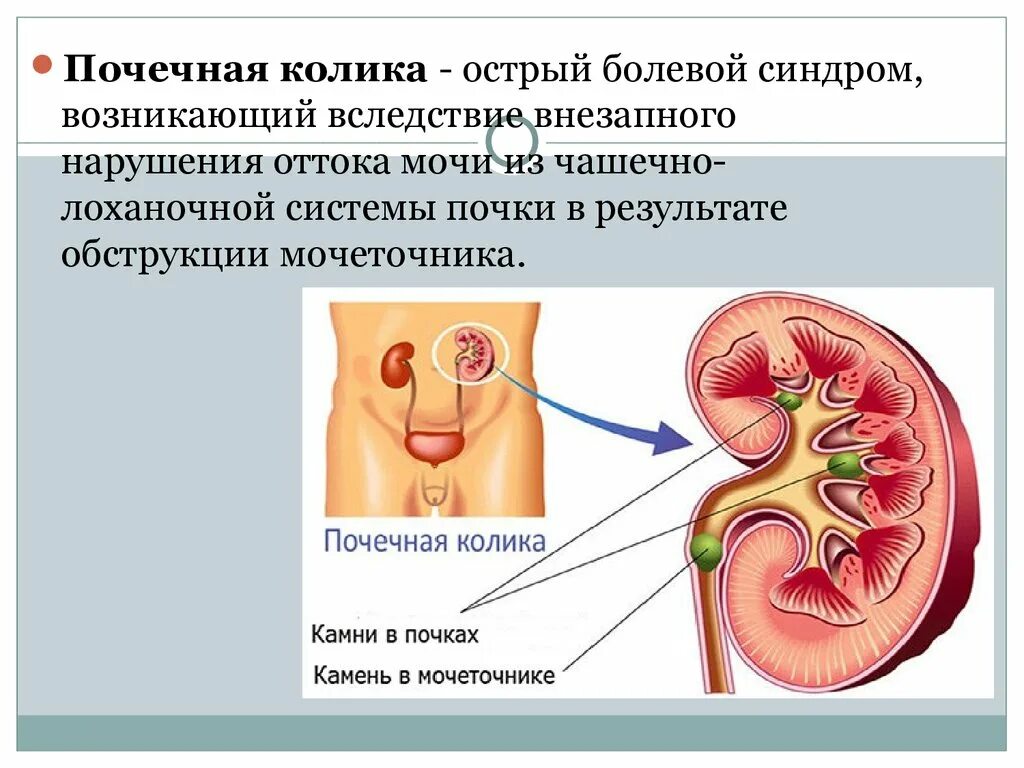 Почечная колика. Синдромы при почечной колике. Синдром почечной колики. Мочекаменная болезнь почечная колика