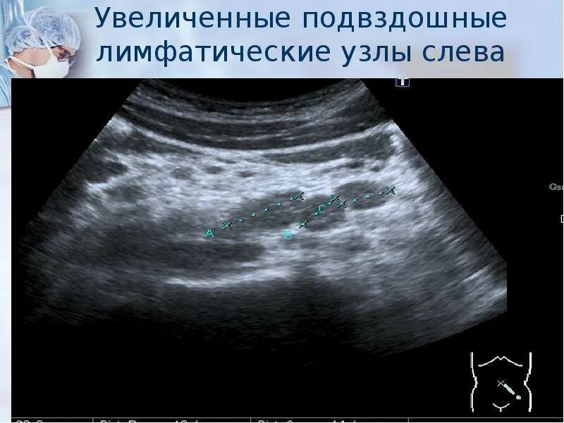 УЗИ лимфатических узлов брюшной полости в норме