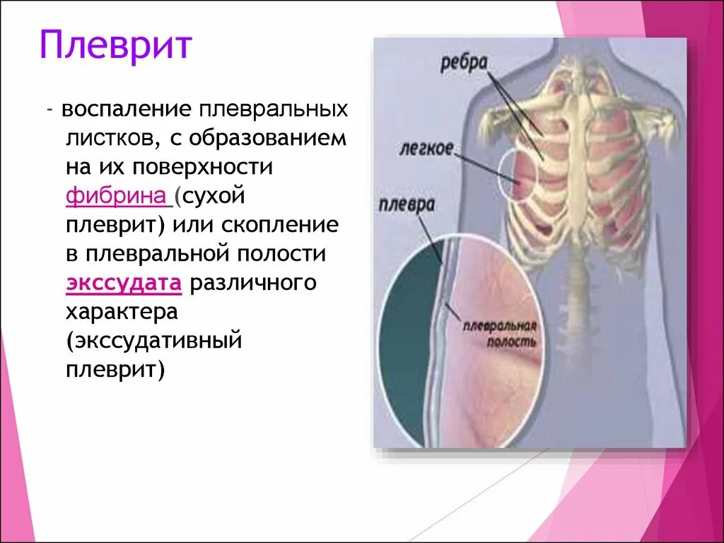 Болят лёгкие при вдохе. Лёгкие плевральная полость. Болит в правом легком при вдохе.