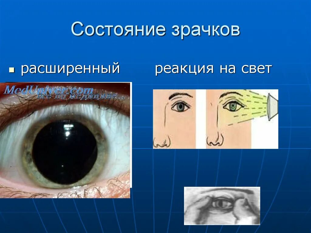 Расширение зрачков на свет. Расширенные зрачки не реагируют на свет. Отсутствие реакции зрачка на свет.