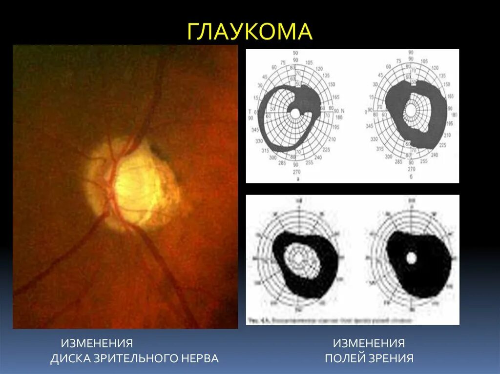 Зрительный нерв при глаукоме. Патологии зрительного нерва глаукома. Глаукома офтальмоскопия. Изменение полей зрения при глаукоме. Изменения зрительного нерва при глаукоме.