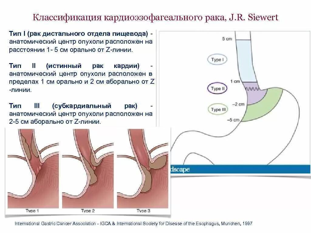 Классификация опухоли пищеводно желудочного перехода. Классификация опухолей кардиоэзофагеального перехода по Siewert. Классификация Зиверт. Эзофагокардиальный отдел пищевода. Нижнее расширение пищевода