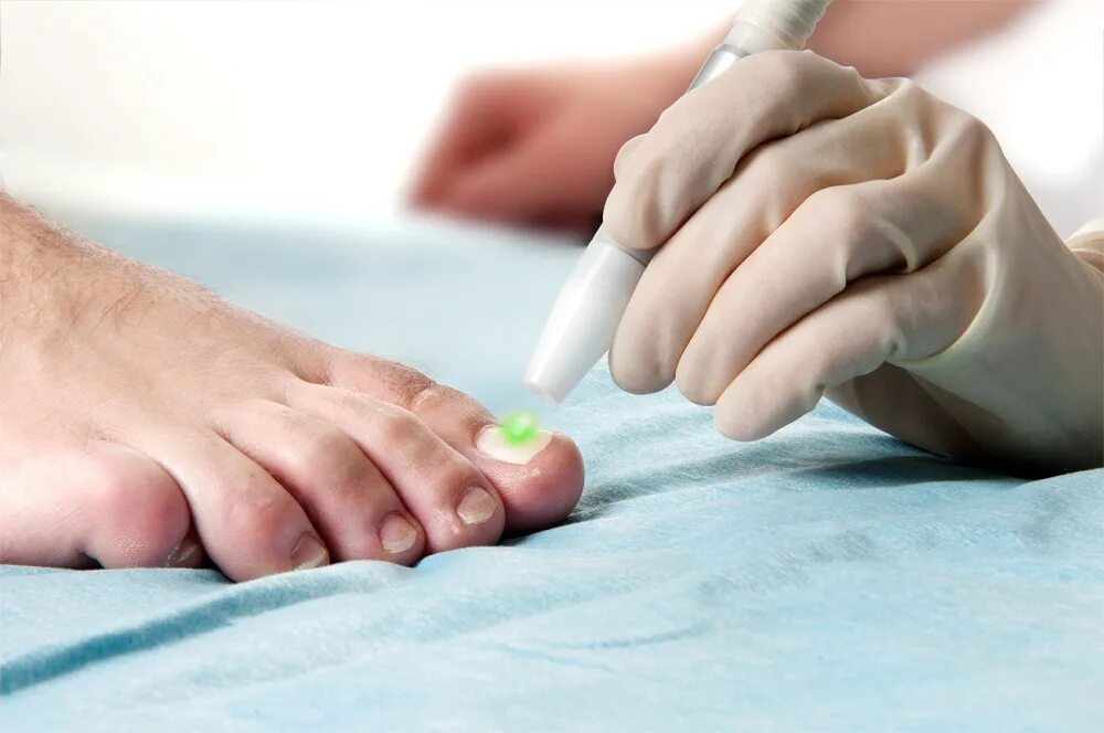 Лечение грибка врач. Онихомикоз онихокриптоз. Подология грибок ногтей. Лазерная терапия грибка ногтей.