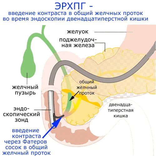 Удаление камня через проток. Ретроградная холангиопанкреатография (РХПГ). Эндоскопия ретроградная панкреатохолангиография.