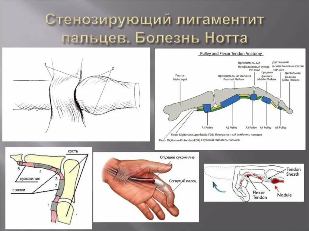 Операция на большом пальце руки. Стенозирующий лигаментит пальца. Стенозирующий лигаментит пальца кисти. Стенозирующий лигаментит. Болезнь Нотта.